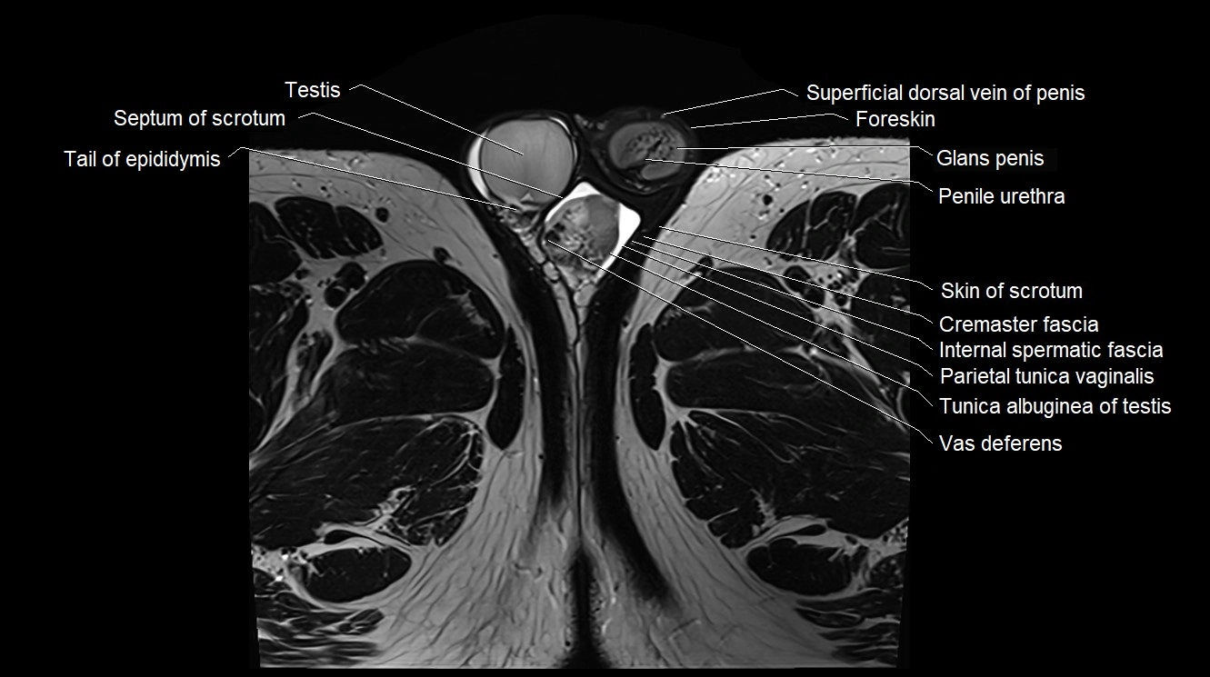 MRI 3T scrotum and penis axial cross sectional anatomy image 32.webp